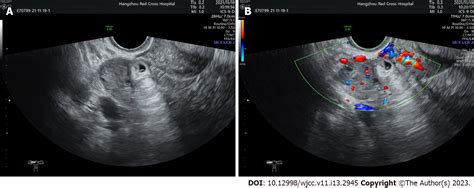 ovarian torsion blood tests|ovarian torsion vs ectopic pregnancy.